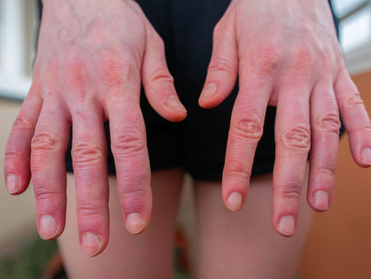 Why do my hands and feet swell in the summer?