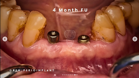 Dental implant placement with periodontal treatment for missing tooth replacement