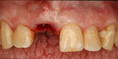 Before and after dental implant crown lengthening procedure