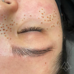 Freckles