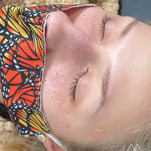 Freckles