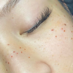 Freckles