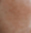 Acne - Care Clinic Apeldoorn