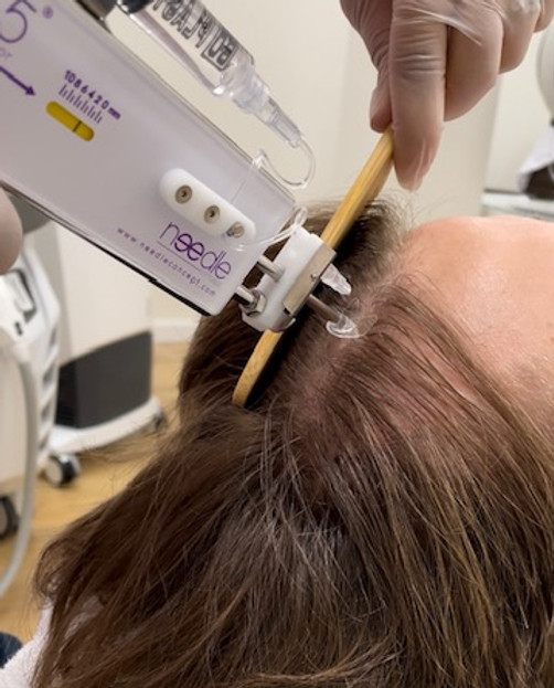 Haaruitval behandeling - Care Clinic huidtherapie