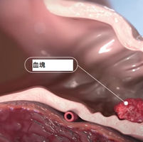 「左心耳封堵術」防中風 房顫患者減血栓上腦【譚冠昶醫生 | 心臟科專科】