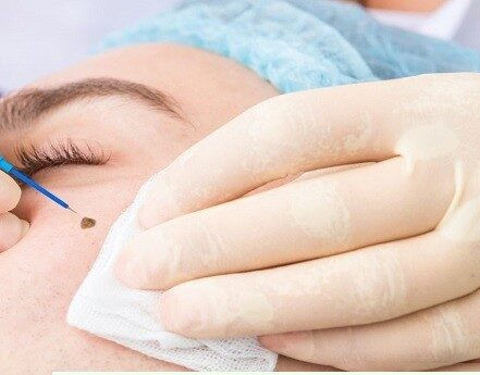 Electrocautery: Your Minimally Invasive Solution for Mole and Wart Removal at Dermaletic Clinic