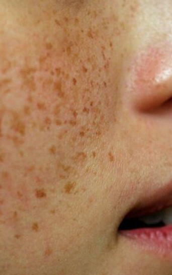 freckles.jpeg