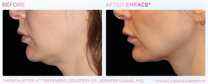 Emface_PIC_Ba-card-female-submentum-cheek-123_ENUS100 (1).png