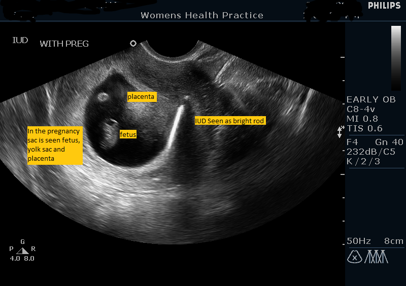 positive pregnancy test with iud Pregnancy Positive You an and IUD Test a have