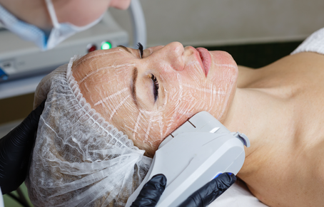 Hifu Treatment in Dubai