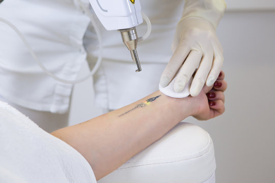 How Does Laser Tattoo Removal Target Ink Without Skin Damage?