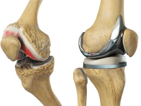 Knee Replacement Surgery in Dubai, UAE