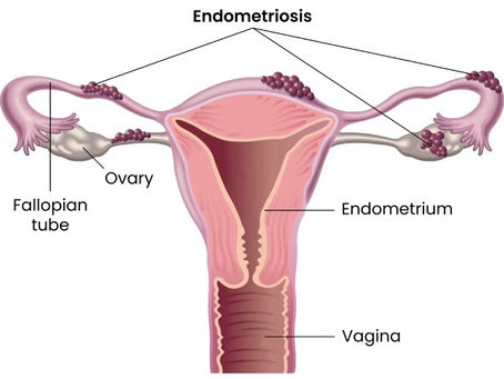 Robotic Endometriosis Surgery in Mumbai