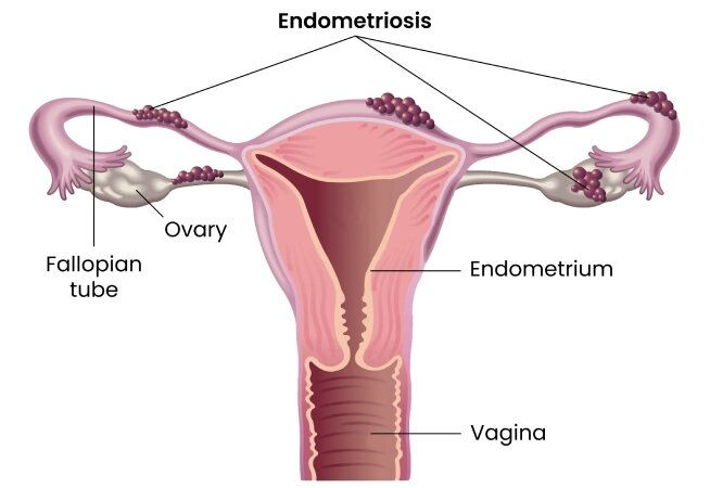 Robotic Endometriosis Surgery In Mumbai