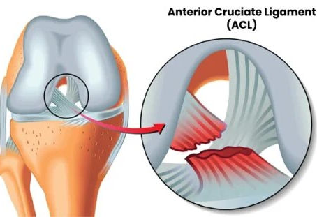 ACL reconstruction surgery in Dubai , UAE