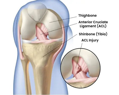 Best ACL Surgery in Dubai