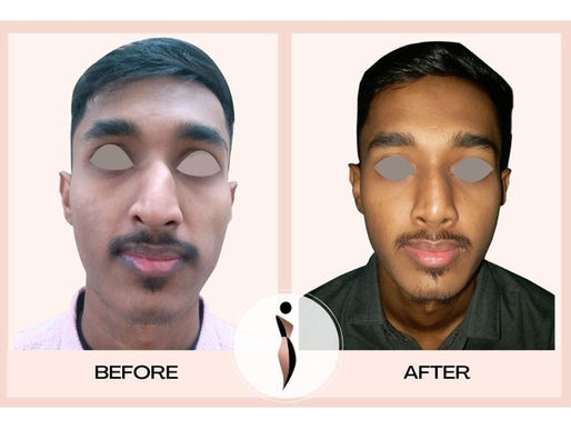 Best rhinoplasty surgeon in India