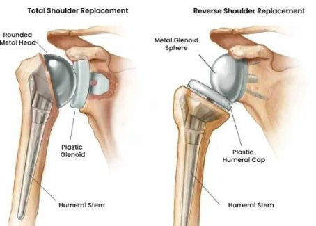 Total Shoulder Replacement in Banglore