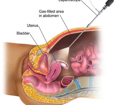 Laparoscopic Hysterectomy in Mumbai with Dr. Maitreyee Parulekar