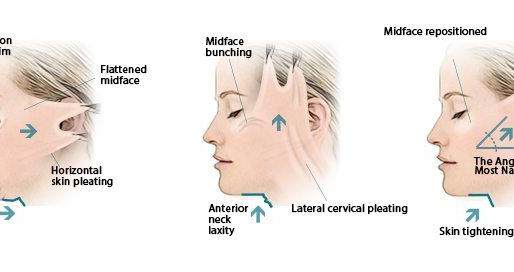 Facelift Surgery in Mumbai