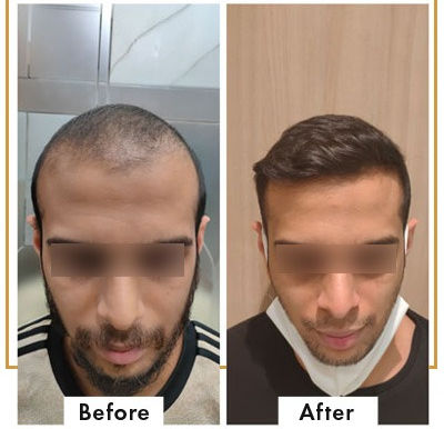 Hair Transplant in Mumbai