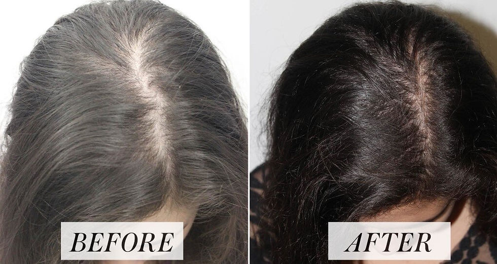 Hair loss treatment in mumbai