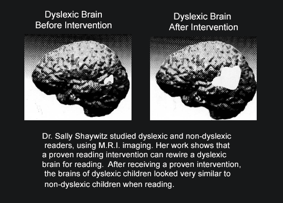 Rewiring the Dyslexic Brain for Reading
