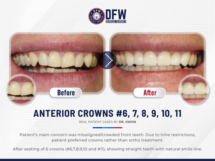 DFW Dental Service in Irving TX 75060 Emergency, Invisalign, Family, Cosmetic - Dental Implants, Tooth Extraction, Dental Checkup, Cleaning & Examinations, Crowns, Bridges, Implants, Restorations, Veneers, Dentures, Partial Dentures, Emergency Dentist, Invisalign Dentist, Kid Friendly Dentist, Root Canal Therapy