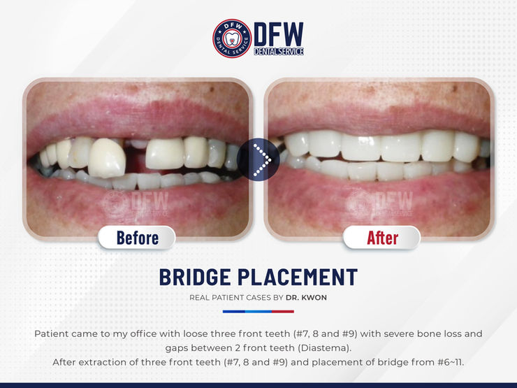 DFW Dental Service in Irving TX 75060 Emergency, Invisalign, Family, Cosmetic - Dental Implants, Tooth Extraction, Dental Checkup, Cleaning & Examinations, Crowns, Bridges, Implants, Restorations, Veneers, Dentures, Partial Dentures, Emergency Dentist, Invisalign Dentist, Kid Friendly Dentist, Root Canal Therapy