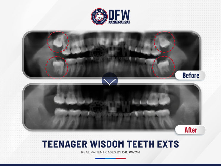 DFW Dental Service in Irving TX 75060 Emergency, Invisalign, Family, Cosmetic - Dental Implants, Tooth Extraction, Dental Checkup, Cleaning & Examinations, Crowns, Bridges, Implants, Restorations, Veneers, Dentures, Partial Dentures, Emergency Dentist, Invisalign Dentist, Kid Friendly Dentist, Root Canal Therapy