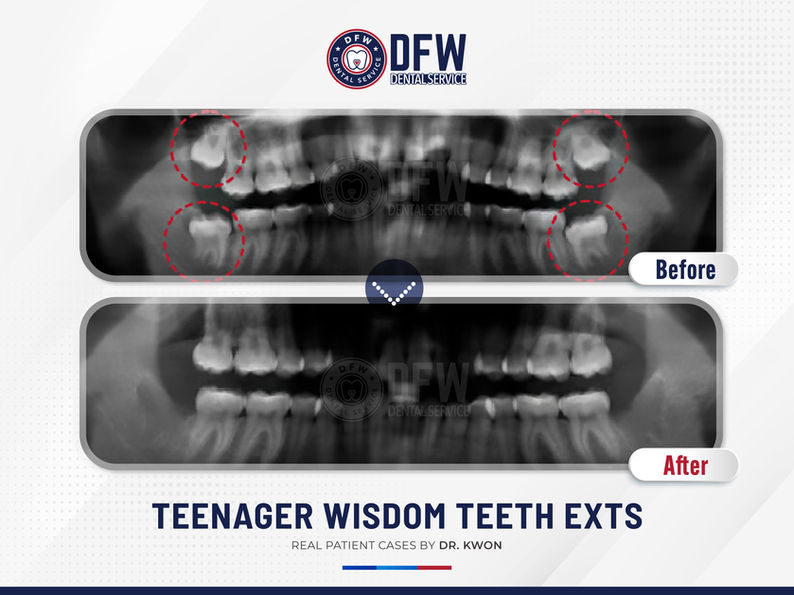 DFW Dental Service in Irving TX 75060 Emergency, Invisalign, Family, Cosmetic - Dental Implants, Tooth Extraction, Dental Checkup, Cleaning & Examinations, Crowns, Bridges, Implants, Restorations, Veneers, Dentures, Partial Dentures, Emergency Dentist, Invisalign Dentist, Kid Friendly Dentist, Root Canal Therapy