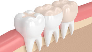 What are Inlays and Onlays? Learn With Your Mckinney, Texas Restorative and Cosmetic Dentist