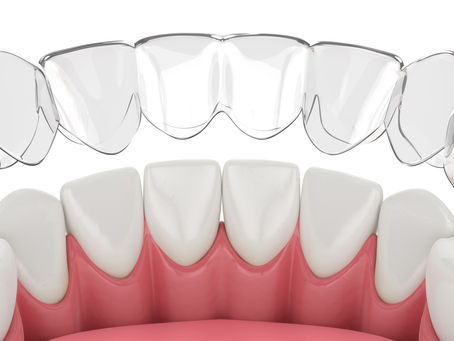 Vancouver, WA Patients Ask: How Do Invisible Aligners Work? Cosmetic & General Dentist Answers