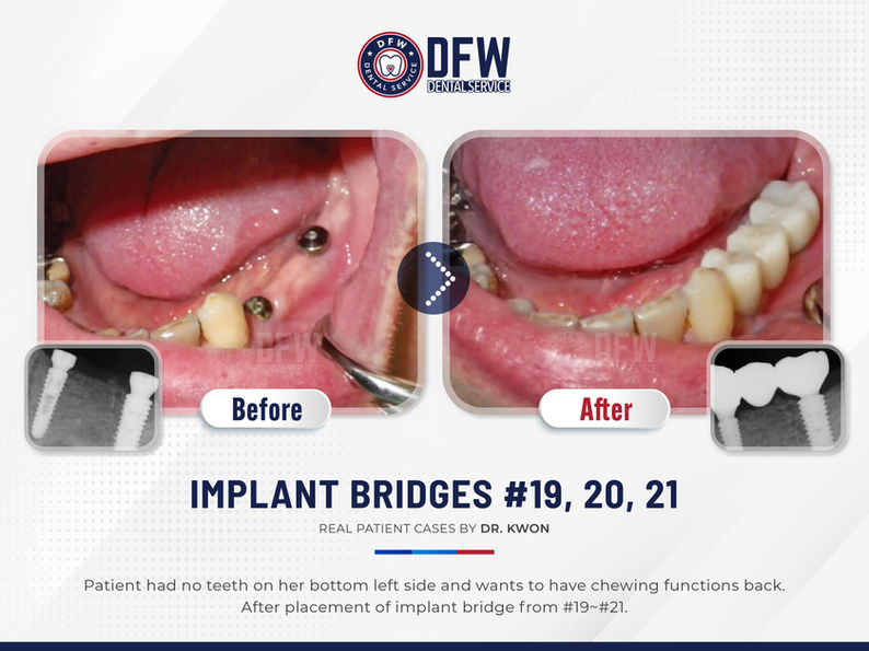 DFW Dental Service in Irving TX 75060 Emergency, Invisalign, Family, Cosmetic - Dental Implants, Tooth Extraction, Dental Checkup, Cleaning & Examinations, Crowns, Bridges, Implants, Restorations, Veneers, Dentures, Partial Dentures, Emergency Dentist, Invisalign Dentist, Kid Friendly Dentist, Root Canal Therapy