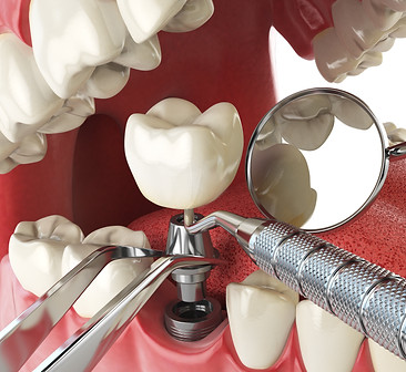 K Family Dentistry in Pflugerville, TX 78660 Emergency, Invisalign, Family, Cosmetic - Laser dentistry, Dental Implants, Crowns, Bridges, Restorations, Veneers, Fillings, Root Canal Therapy, ClearCorrect, Dentures, Teeth Whitening, Inlays and Onlays, Sedation Dentistry, Emergency Dentist, Kid Friendly Dentist, Dental Checkup, Cleaning & Examinations