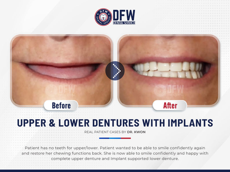DFW Dental Service in Irving TX 75060 Emergency, Invisalign, Family, Cosmetic - Dental Implants, Tooth Extraction, Dental Checkup, Cleaning & Examinations, Crowns, Bridges, Implants, Restorations, Veneers, Dentures, Partial Dentures, Emergency Dentist, Invisalign Dentist, Kid Friendly Dentist, Root Canal Therapy