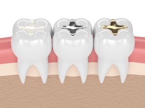 What are the 4 Main Tooth Filling Materials? Mckinney, Texas Family & General Dentist Explains