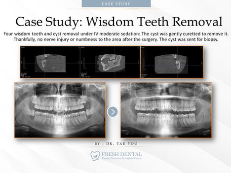 Fresh Dental Family Emergency Dentistry & Implant Center in Dallas, TX 75248 - Dental Implant, Cosmetic Dentistry, Family Dentistry, Emergency Dental Care, Teeth Whitening, Dental Checkups, Dental Cleaning, Fluoride Treatments, Dental Sealants, Oral Cancer Screening, Gum Disease Prevention, Invisalign, Clear Aligner, Porcelain Veneers, Smile makeover, Tooth fillings, Cosmetic Bonding, Dental Crown, Dental Bridges, Wisdom Tooth Extractions, Root Canal Therapy