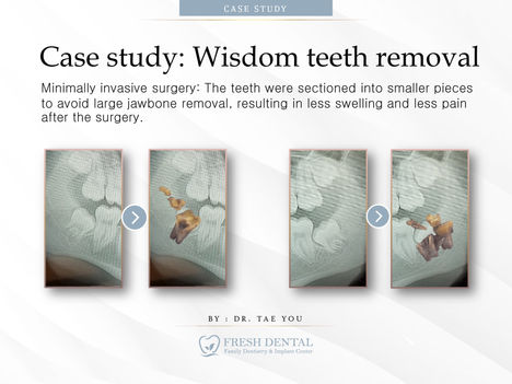 Fresh Dental Family Emergency Dentistry & Implant Center in Dallas, TX 75248 - Dental Implant, Cosmetic Dentistry, Family Dentistry, Emergency Dental Care, Teeth Whitening, Dental Checkups, Dental Cleaning, Fluoride Treatments, Dental Sealants, Oral Cancer Screening, Gum Disease Prevention, Invisalign, Clear Aligner, Porcelain Veneers, Smile makeover, Tooth fillings, Cosmetic Bonding, Dental Crown, Dental Bridges, Wisdom Tooth Extractions, Root Canal Therapy