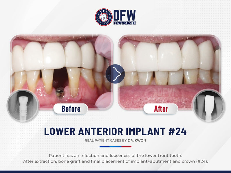 DFW Dental Service in Irving TX 75060 Emergency, Invisalign, Family, Cosmetic - Dental Implants, Tooth Extraction, Dental Checkup, Cleaning & Examinations, Crowns, Bridges, Implants, Restorations, Veneers, Dentures, Partial Dentures, Emergency Dentist, Invisalign Dentist, Kid Friendly Dentist, Root Canal Therapy