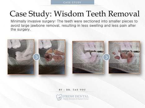 Fresh Dental Family Emergency Dentistry & Implant Center in Dallas, TX 75248 - Dental Implant, Cosmetic Dentistry, Family Dentistry, Emergency Dental Care, Teeth Whitening, Dental Checkups, Dental Cleaning, Fluoride Treatments, Dental Sealants, Oral Cancer Screening, Gum Disease Prevention, Invisalign, Clear Aligner, Porcelain Veneers, Smile makeover, Tooth fillings, Cosmetic Bonding, Dental Crown, Dental Bridges, Wisdom Tooth Extractions, Root Canal Therapy