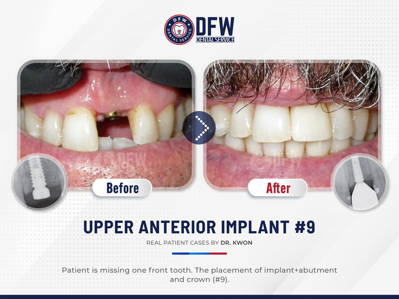 DFW Dental Service in Irving TX 75060 Emergency, Invisalign, Family, Cosmetic - Dental Implants, Tooth Extraction, Dental Checkup, Cleaning & Examinations, Crowns, Bridges, Implants, Restorations, Veneers, Dentures, Partial Dentures, Emergency Dentist, Invisalign Dentist, Kid Friendly Dentist, Root Canal Therapy