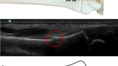 症例〈橈骨遠位端部若木骨折〉