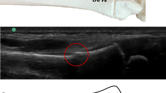 症例〈橈骨遠位端部若木骨折〉