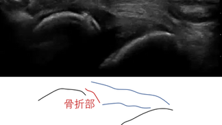 症例〈腓骨遠位端部裂離骨折〉