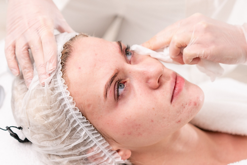 Acne Treatment_edited_edited.png