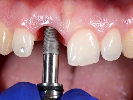 Imagem clínica em close mostrando a instalação de um implante dentário na região anterior superior, com destaque para a gengiva afastada, dentes naturais adjacentes e o instrumento de inserção do implante em ação. Logotipo da Lunni Odontologia visível no canto inferior esquerdo.