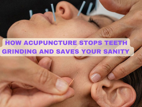 Close-up of a patient receiving acupuncture treatment on the masseter muscle and jawline for bruxism and teeth grinding relief in Tribeca with text ovelay