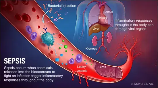 Image credit - https://newsnetwork.mayoclinic.org/n7-mcnn/7bcc9724adf7b803/uploads/2018/11/a-medical-illustration-of-sepsis-original.jpg