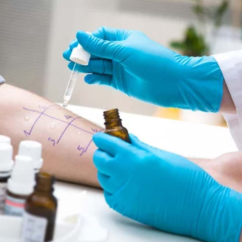 Skin prick allergy test